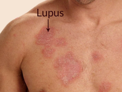 Lupus Treatment In Pune