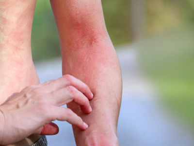 Rash with Joint Pain Treatment In Pune